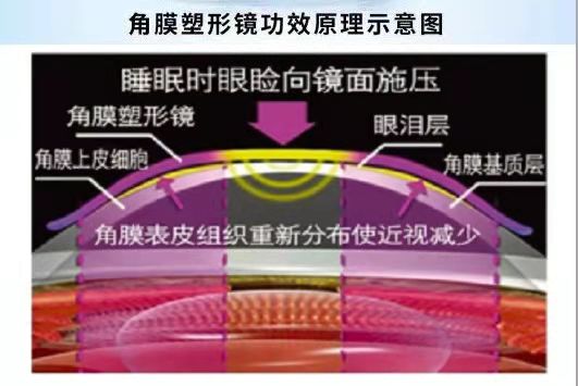 角膜塑形鏡能治愈近視嗎？